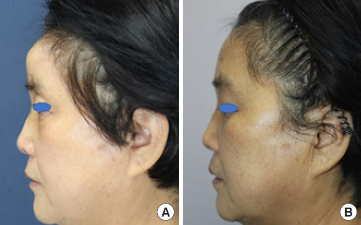 Intraosseous vascular malformation of the skull: a case report and literature review.