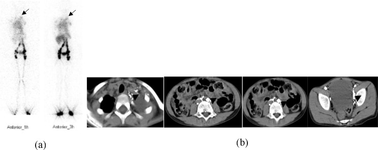 Diagnostic value of combined CT lymphangiography and <sup>99</sup>Tc<sup>m</sup>-DX lymphoscintigraphy in primary chylopericardium.