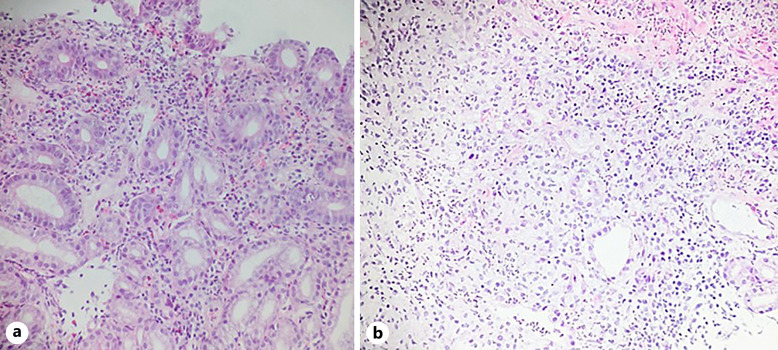 Esophageal Tuberculosis as a Rare Cause of Dysphagia: Case Report.