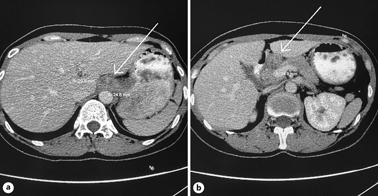 Esophageal Tuberculosis as a Rare Cause of Dysphagia: Case Report.