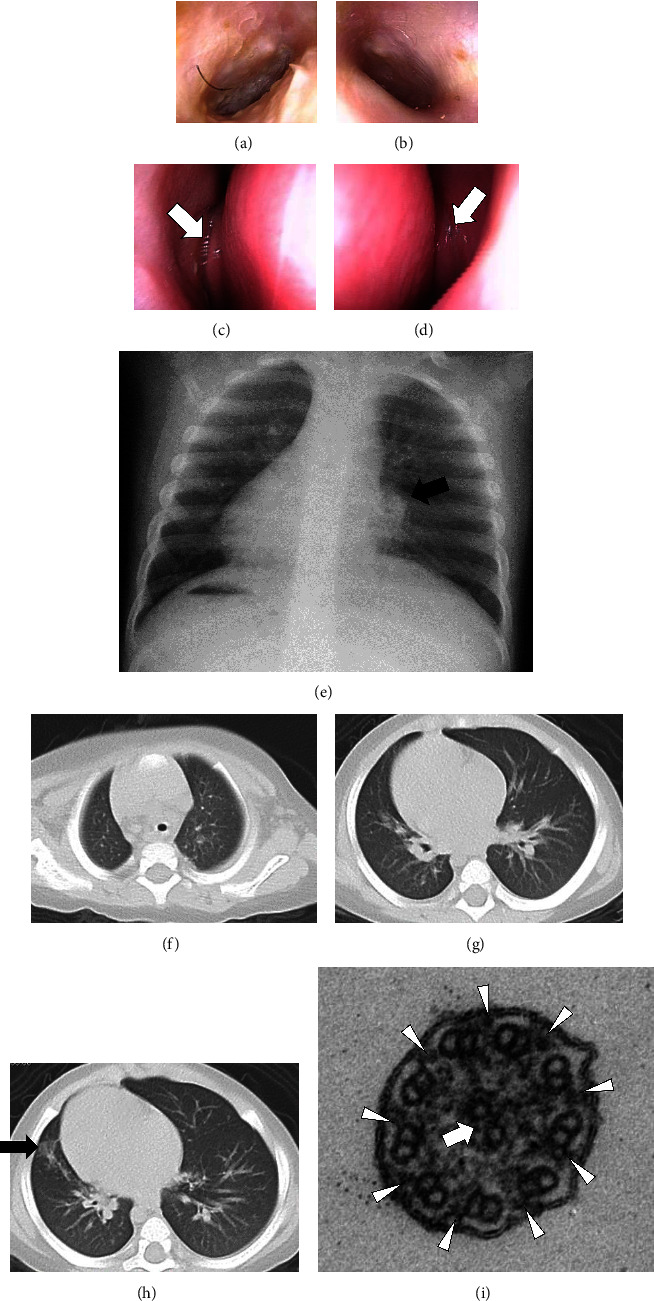 Two Pediatric Cases of Primary Ciliary Dyskinesia Caused by Loss-of-Function Variants in Oral-Facial-Digital Syndrome Gene, <i>OFD1</i>.