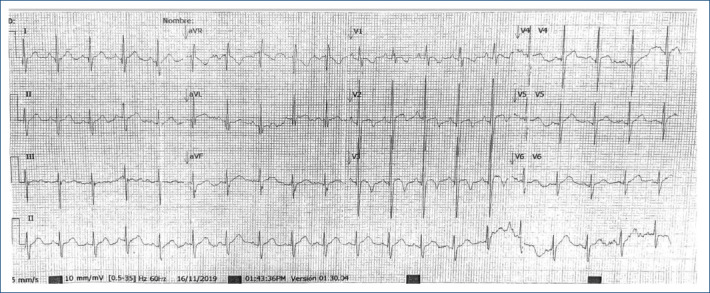 [Late onset complete atrioventricular block following surgical closure of atrioventricular defect: case report].