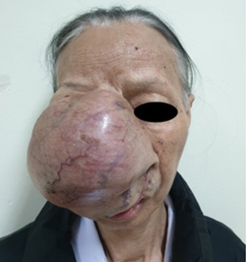 Successful surgical interventions for a giant and complicated myoepithelial carcinoma: a case report.