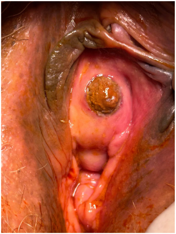 Urethral Calculus as an Uncommon Cause of Acute Urinary Retention in Women Diagnosis and Management: A Case Report.