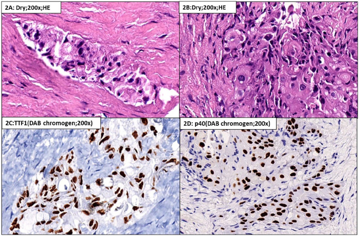 <i>VCL::ROS1</i>: A Novel ROS1 Oncogenic Fusion Detected on Next Generation Sequencing.