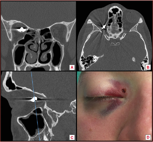 Endoscopic transnasal approach to remove an intraorbital bullet: systematic review and case report.