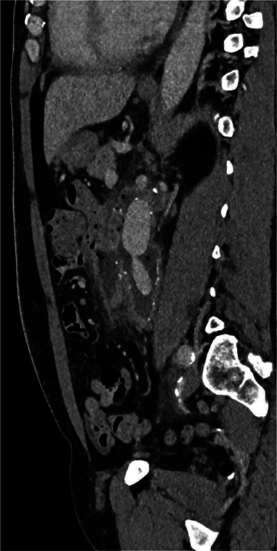 Aortoenteric Fistula with Digestive Contrast Material Leaking in the Aneurysmal Sac.