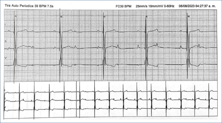 [Late onset complete atrioventricular block following surgical closure of atrioventricular defect: case report].