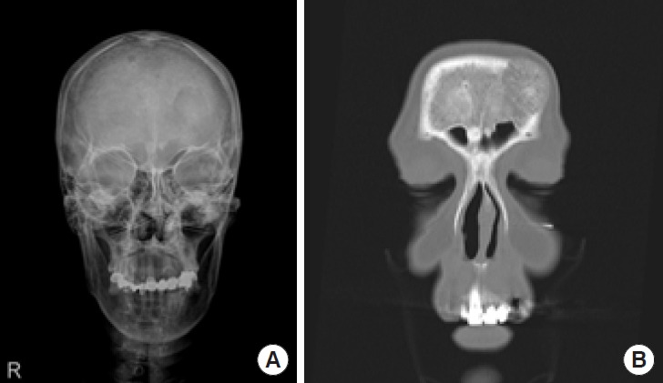 Intraosseous vascular malformation of the skull: a case report and literature review.