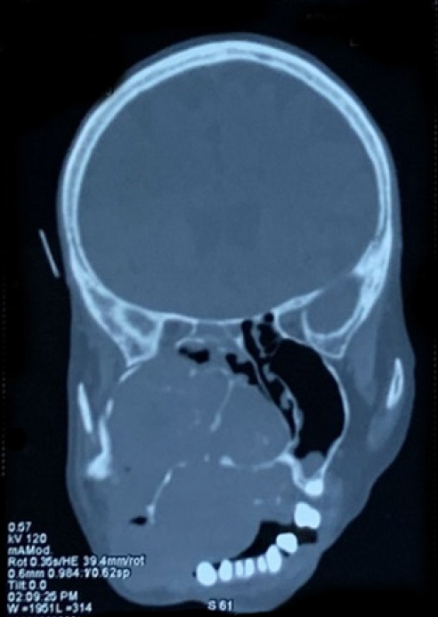 Successful surgical interventions for a giant and complicated myoepithelial carcinoma: a case report.