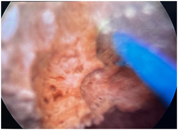 Urethral Calculus as an Uncommon Cause of Acute Urinary Retention in Women Diagnosis and Management: A Case Report.