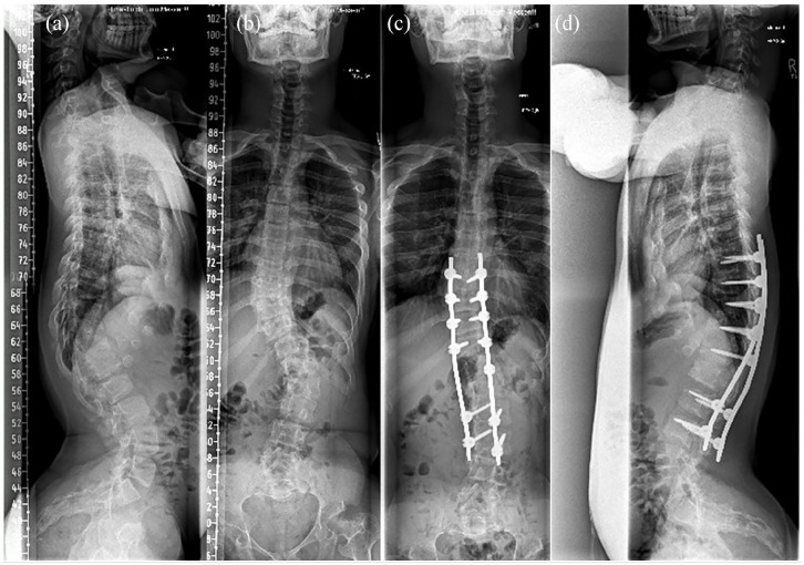 Achondroplasia current concept of orthopaedic management.