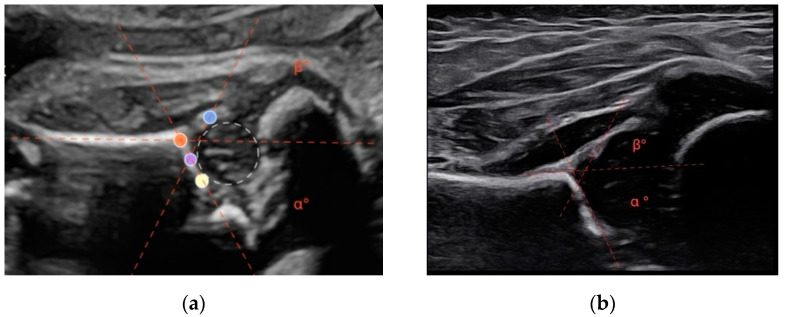The Feasibility of Prenatal Ultrasonic Screening for Developmental Dysplasia of the Hip.