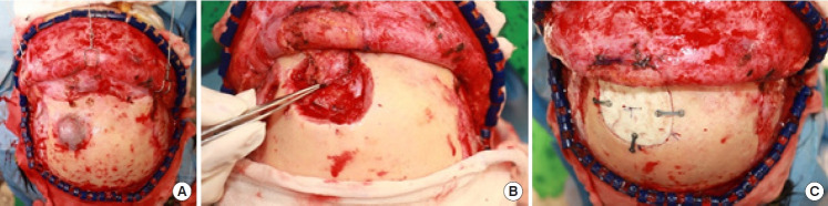 Intraosseous vascular malformation of the skull: a case report and literature review.