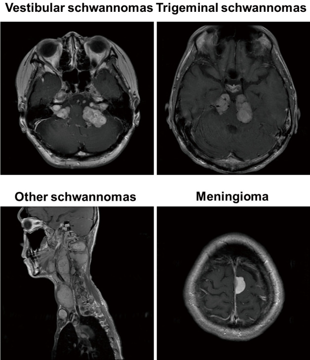 Historical Development of Diagnostic Criteria for NF2-related Schwannomatosis.