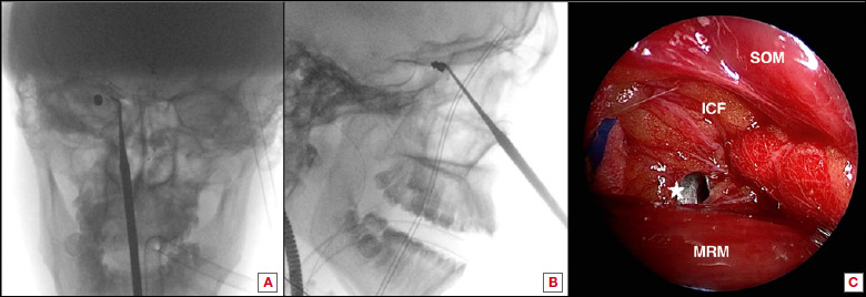 Endoscopic transnasal approach to remove an intraorbital bullet: systematic review and case report.