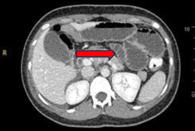 A rare convergence: Gangrenous bowel secondary to closed-loop obstruction with elevated urine amylase levels - A comprehensive case report.