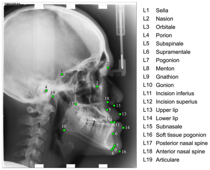 A Survey Study of the 3D Facial Landmark Detection Techniques Used as a Screening Tool for Diagnosis of the Obstructive Sleep Apnea Syndrome.