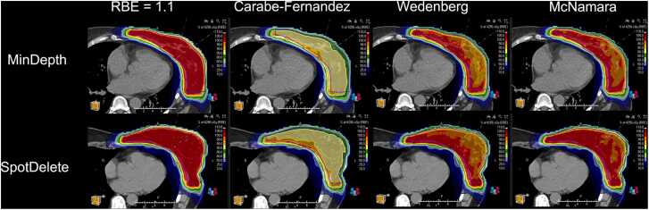 Reducing Radiation Dermatitis for PBS Proton Therapy Breast Cancer Patients Using SpotDelete.