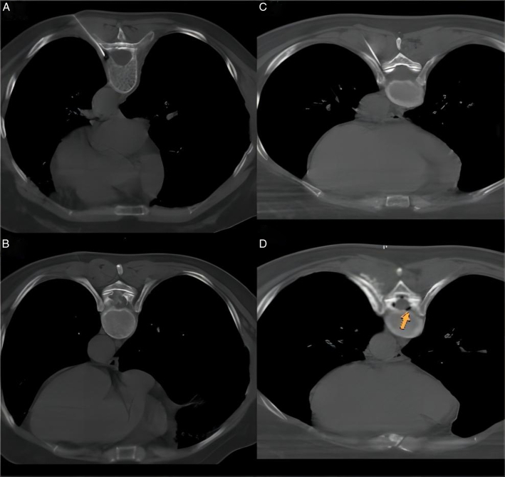 Computed Tomography-Guided Dorsal Root Ganglion Ozone Injection Combined With Pulsed Radiofrequency for Acute Herpes Zoster Neuralgia Treatment of Middle-aged and Elderly People: A Randomized, Double-blinded, Controlled Trial.