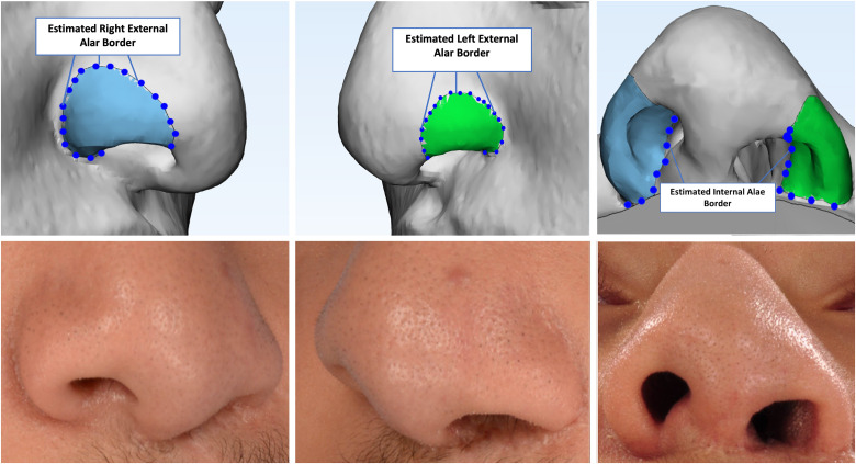 Alar Asymmetry in Patients with Unilateral Cleft Lip: Implications for Secondary Rhinoplasty.