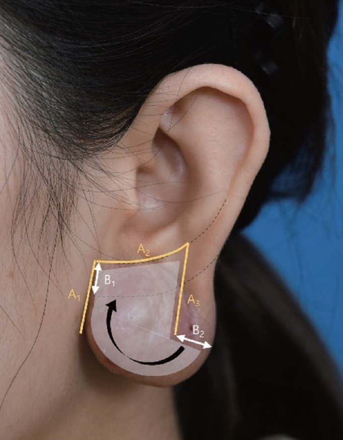 Ear lobule reduction using a sub-antitragal groove technique in patients with angiolymphoid hyperplasia with eosinophilia on the earlobe: a case report and literature review.