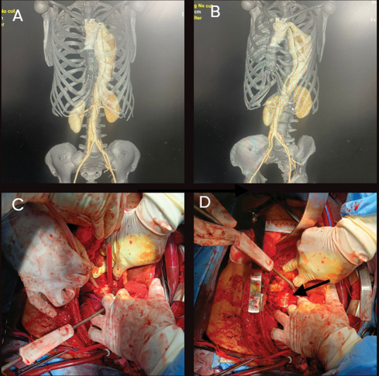 Mechanical Injury of Thoracic Aorta by Elephant Trunk Graft Limb following Frozen Elephant Trunk Procedure.