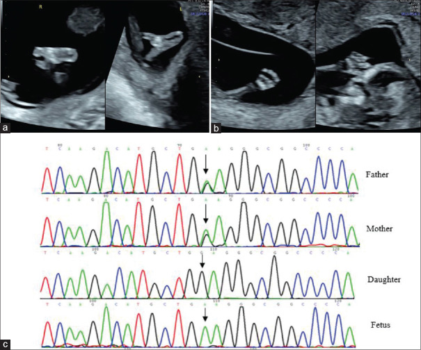 Early Prenatal Detection of Recessive Split-hand/Foot Malformation Caused by a Homozygous Variant of <i>WNT10B</i>.
