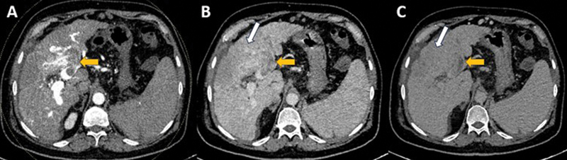 Multiphasic Computed Tomography Enhancement Characteristics and Utility of Delayed Phase in Infiltrative Hepatocellular Carcinoma.