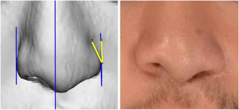 Alar Asymmetry in Patients with Unilateral Cleft Lip: Implications for Secondary Rhinoplasty.