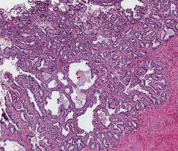 Pseudomyxoma Peritonei in a Case of Carcinoma Cervix: Subtle Finding With Implications on Management and Prognosis.