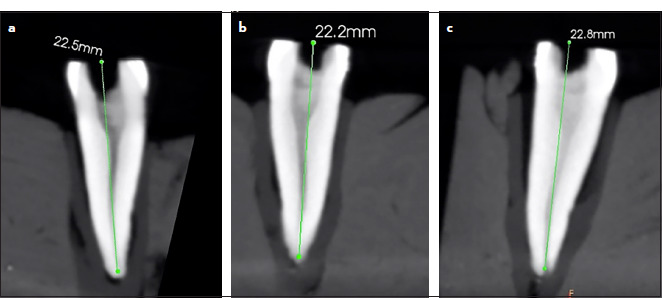 Accuracy of Working Length Measurement Using Cone Beam Computed Tomography at Three Field of View Settings, Conventional Radiography, and Electronic Apex Locator: An Ex-vivo Study.
