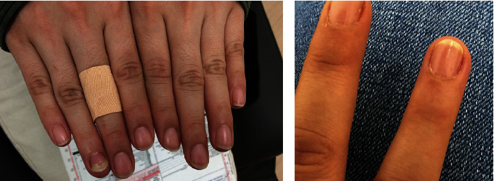 Therapeutic Response of Alopecia Areata-Associated Nail Changes to Baricitinib.