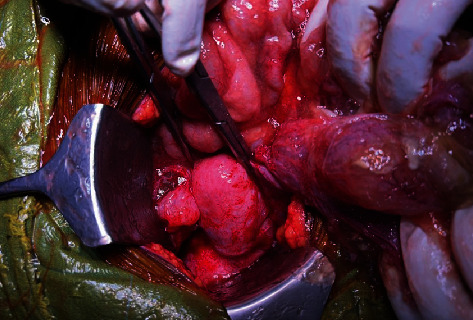 Pseudomyxoma Peritonei in a Case of Carcinoma Cervix: Subtle Finding With Implications on Management and Prognosis.