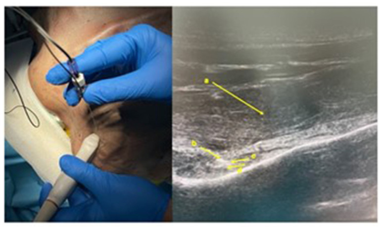 Identification of the Suprascapular Nerve with Minimal Volume of Contrast Medium: A Cadaveric Case Study.