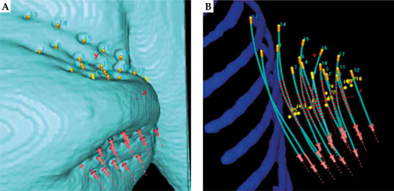 Electromagnetic tracking for integrated quality assurance in breast interstitial brachytherapy: The impact of registration method.