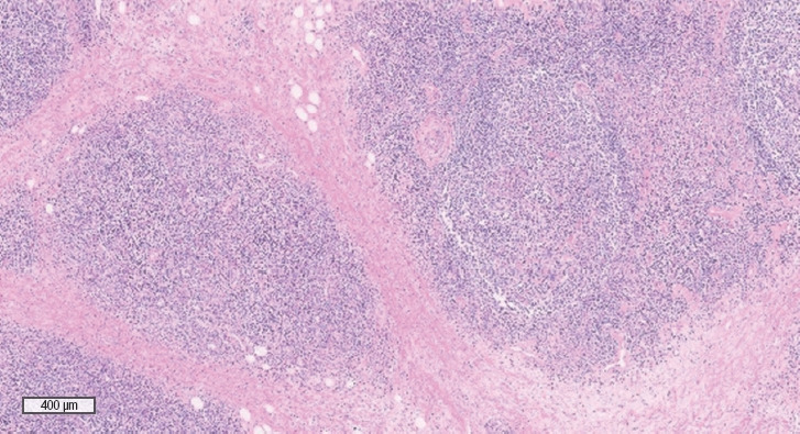 Ear lobule reduction using a sub-antitragal groove technique in patients with angiolymphoid hyperplasia with eosinophilia on the earlobe: a case report and literature review.