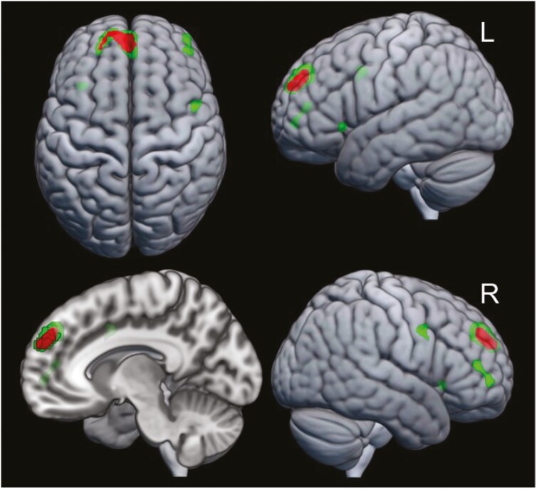 Brain mGlu5 Is Linked to Cognition and Cigarette Smoking but Does Not Differ From Control in Early Abstinence From Chronic Methamphetamine Use.