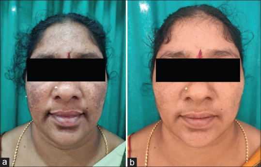 A Randomized Study to Evaluate the Efficacy of Oral Tranexamic Acid, Modified Kligman's Formula, and Placebo Cream in Melasma.