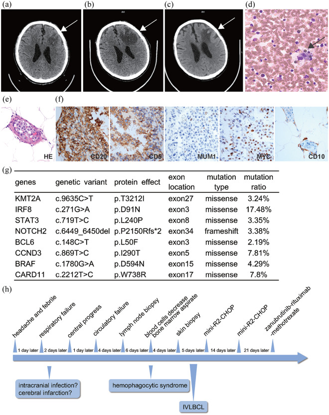 Successful treatment of hemophagocytic intravascular large B-cell lymphoma with CNS involvement with BTK inhibitor combined with rituximab and high-dose methotrexate.