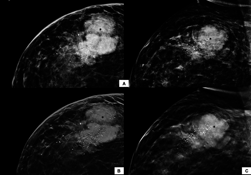 Comparison of Full-Field Digital Mammography with Synthesized Mammography from Tomosynthesis in a Diagnostic population: Prospective Study.