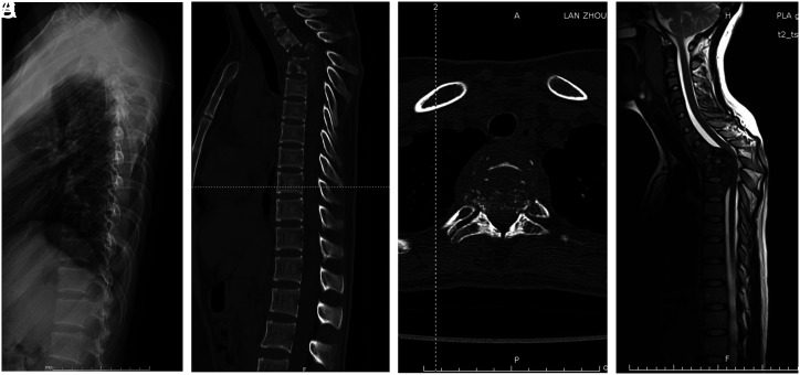 Clinical effect of posterior-only approach debridement, intervertebral fusion, and internal fixation for upper thoracic tuberculosis.