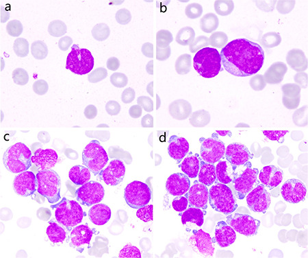 Cleaved Leukemic Blast Cells, Vacuolation, and Pseudopodia-like Cytoplasmic Projections in Acute Myeloid Leukemia with <i>TLS::ERG</i>