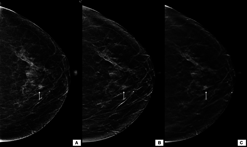 Comparison of Full-Field Digital Mammography with Synthesized Mammography from Tomosynthesis in a Diagnostic population: Prospective Study.