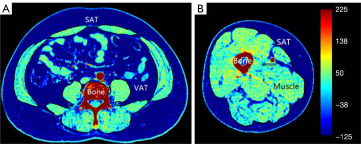 Assessment of body compositions in the prediction of metabolic syndrome in adults.