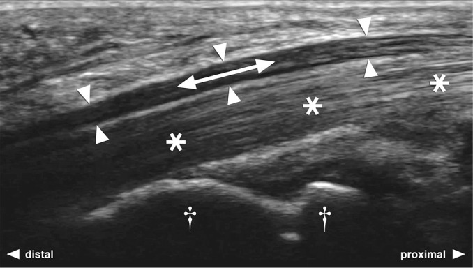 Successful evaluation of a new image-based parameter for the diagnosis of carpal tunnel syndrome: ultrasound assessment of longitudinal median nerve gliding in patients, healthy volunteers, and cadavers.