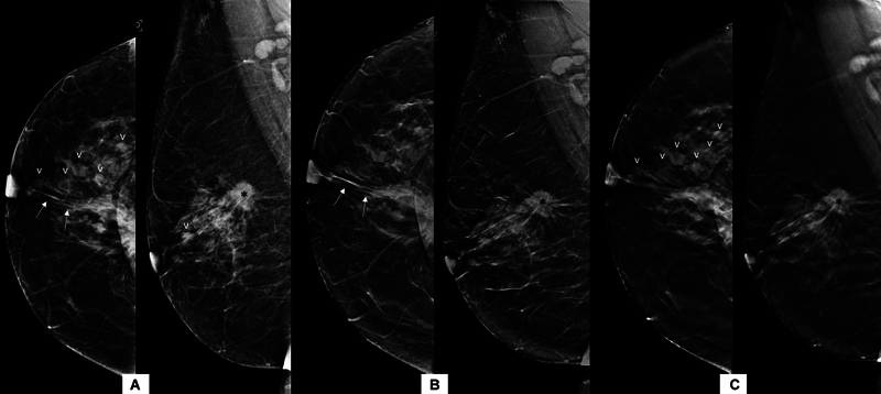 Comparison of Full-Field Digital Mammography with Synthesized Mammography from Tomosynthesis in a Diagnostic population: Prospective Study.