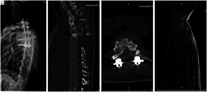 Clinical effect of posterior-only approach debridement, intervertebral fusion, and internal fixation for upper thoracic tuberculosis.