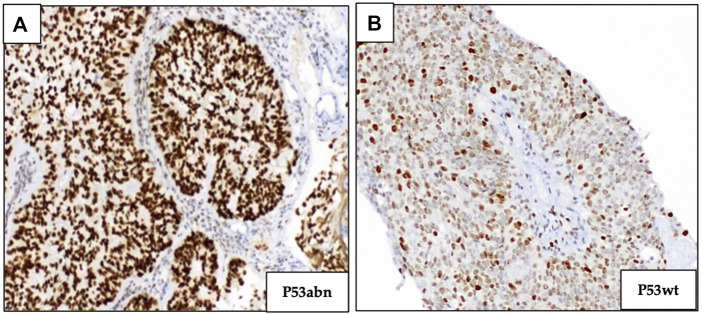 Molecular classification of endometrial cancer: preliminary experience from a single Portuguese academic center.