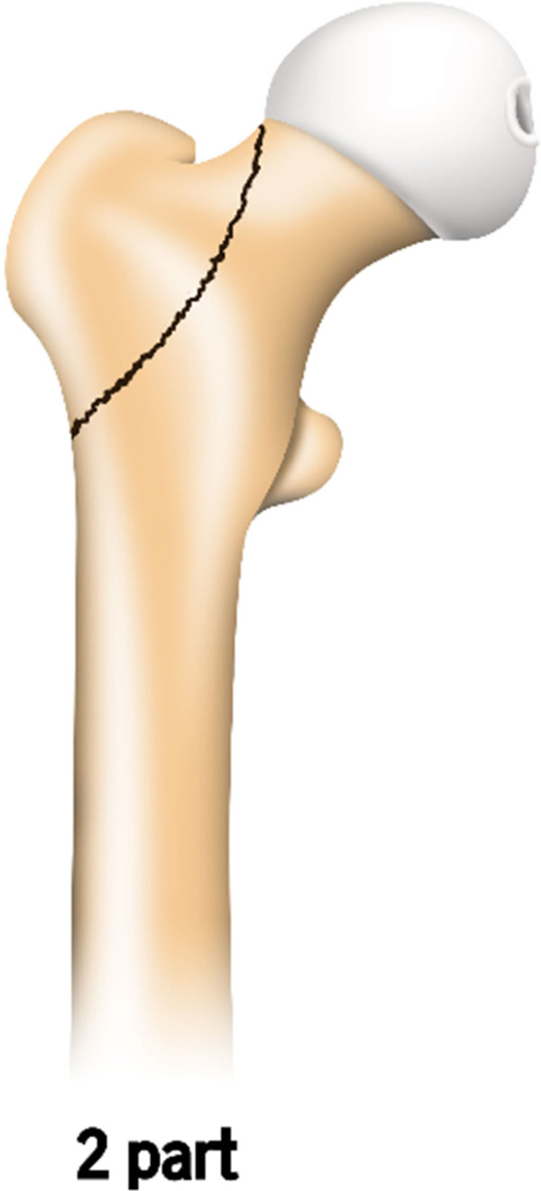 Treatment outcomes of concomitant ipsilateral neck and trochanteric fractures using Gamma3 nails with U-blade lag screws.